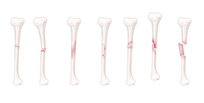 bones structure broken bones
