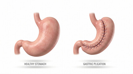 Fototapeta premium Gastric Plication Surgery for Weight Loss Treatment