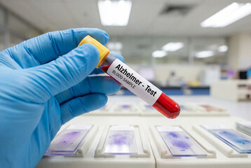 Fototapeta premium Gloved hand holding blood sample tube labeled alzheimer test