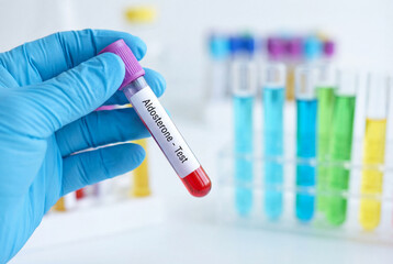 Fototapeta premium Scientist hand holding aldosterone blood test tube