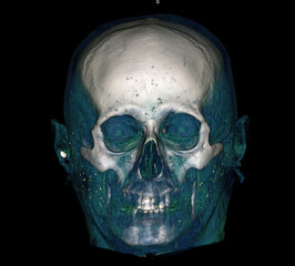 3D CT scan of skull with color segmentation showing cranial and facial bones. © Amri