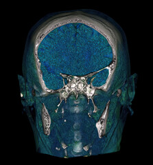 3D CT scan of skull with color segmentation showing cranial and facial bones. © Amri