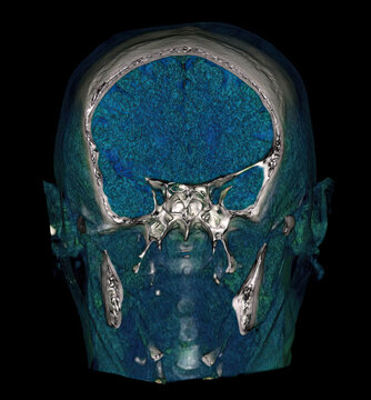 3D CT scan of skull with color segmentation showing cranial and facial bones.