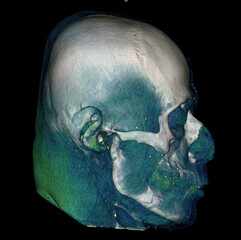 3D CT scan of skull with color segmentation showing cranial and facial bones. © Amri