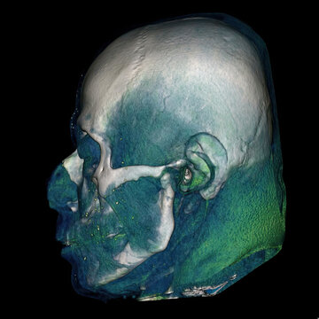 3D CT scan of skull with color segmentation showing cranial and facial bones.