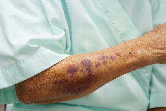 Ecchymosis, elderly bleeding on her arm after taking aspirin.
