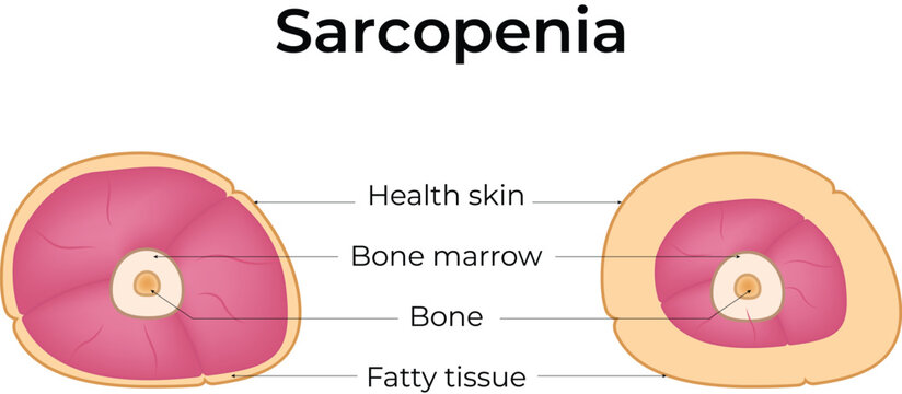 Sarcopenia Muscle Loss and Healthy Limb Cross-Section Comparison Design Vector