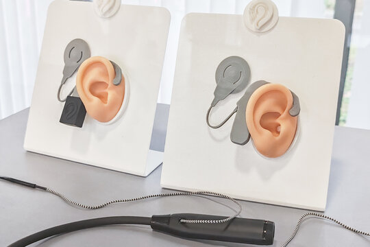 External hearing device and cochlear implant processor mounted on anatomical ear model. Modern audiology equipment for hearing restoration.