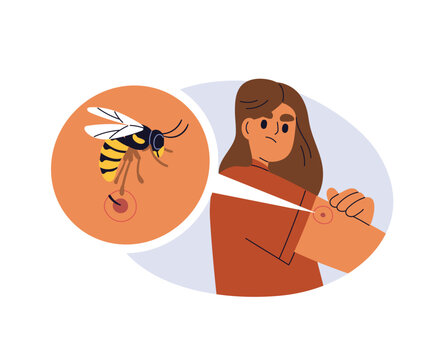 Bee stinging with stinger in skin. Insect bite. Allergy, inflammation, itch and red mark, spot on arm. Allergic reaction, irritation, redness. Flat vector illustration isolated on white background