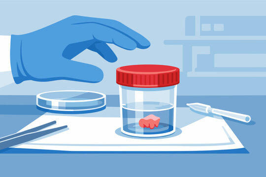 Medical laboratory vector illustration of a gloved hand reaching for a sterile specimen container with a biopsy tissue sample, including surgical tweezers, petri dish, and clinical lab equipment.