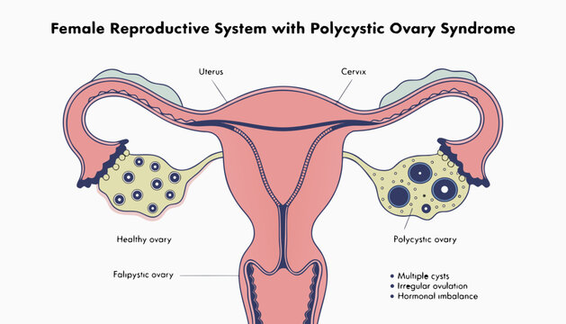 Flat illustration of female reproductive system with polycystic ovary syndrome medical diagram showing uterus ovaries and cysts pcos concept