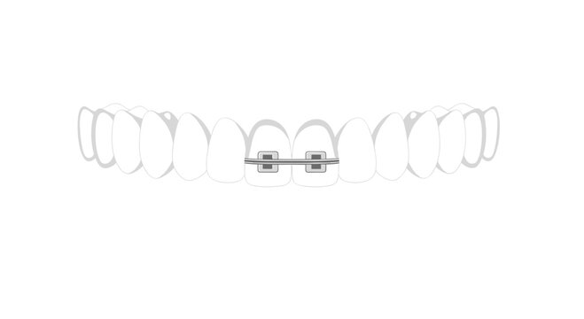 The central incisor teeth are fitted with a small metal orthodontic wire and two square brackets to show a dental correction procedure on a clean white background.