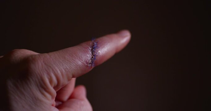 Close up finger with surgical sutures in warm indoor light Healing skin tissue slight swelling and careful medical aftercare shown with shallow depth of field