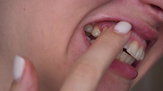 Macro close-up of woman touching painful gums with finger. Toothache, dental problem, oral health and sensitivity concept.