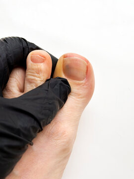 Close-up of bruised toenail on human foot examined by gloved hand, podiatry and nail trauma concept.