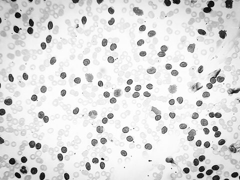 Acute leukemia. Microscopic image of blood cells. Blast cells seen. 