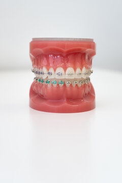 Anatomical human jaw model with installed metal braces and archwire for bite adjustment and malocclusion treatment demonstration in stomatology university classroom or clinic office.