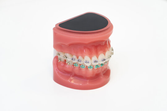 White teeth with orthodontic metal brackets and colorful ligatures showing aesthetic results of stomatological treatment for perfect smile and professional teeth straightening care.