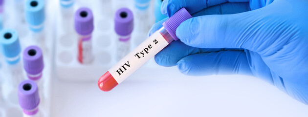Fototapeta premium Doctor holding HIV type 2 blood test tube explaining detection of human immunodeficiency virus infection, immune status evaluation and differential diagnosis in clinical laboratory diagnostics