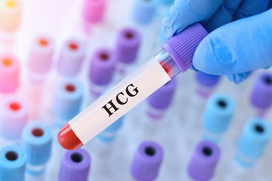 Doctor holding HCG blood test tube explaining pregnancy detection, hormone level measurement and diagnosis of reproductive and gestational conditions in clinical laboratory diagnostics