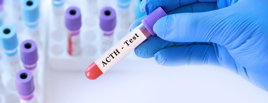 ACTH progesterone blood test for adrenal and pituitary hormone function assessment with doctor holding laboratory sample tube during endocrine diagnostics and clinical analysis copy space
