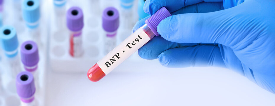 Doctor holding BNP blood test tube explaining assessment of heart failure severity, cardiac stress and diagnosis of cardiovascular disease in clinical laboratory diagnostics