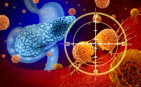 Pancreatic Cancer Treatment targeted therapy medical illustration and Pancreas malignant tumors with a microscopic magnification of malignant tumor cells dividing and spreading as a carcinoma diagnosi