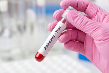 Fototapeta premium Doctor hand holding blood sample tube labeled alzheimer test in clinic
