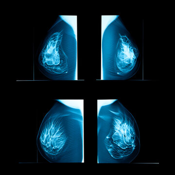 Four Blue Radiographic Breast Images on Black Background mammogram radiology