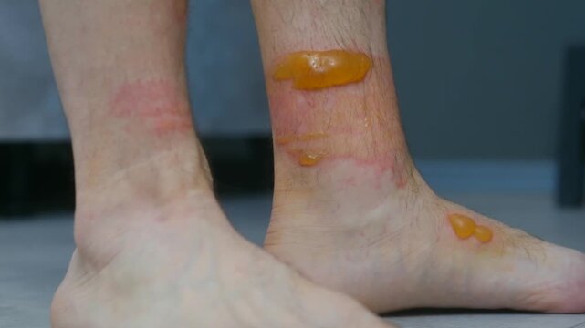 Closeup person leg with severe second degree burns, showing painful large yellow blisters, red inflamed skin while walking slowly, indicating serious thermal injury or accident