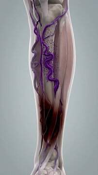 Varicose vein blood pooling leg anatomy medical illustration of venous system and circulation concept, swollen vessel and inflammation lower limb calf, vascular disease with pain neutral background