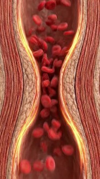 High blood pressure vessel stress artery atherosclerosis plaque cholesterol buildup blood flow through narrowed artery tension risk for cardiovascular health concept illustration bloodstream