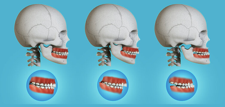Human teeth with all 3 classes of Malocclusion-A holistic view. Medically accurate orthodontic 3D illustration.