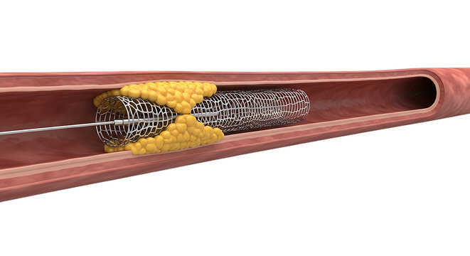Coronary stenting angioplasty procedure clearing plaque blocked artery on transparent background