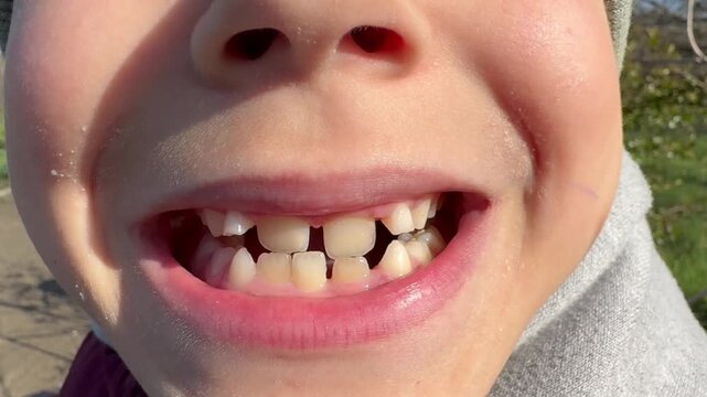 the child exhibits a smile with missing teeth and a wide smile with a diastema,video