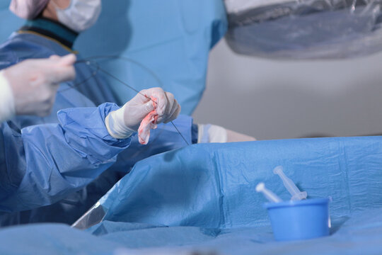 Surgery on blood vessels. Removal of blood clots. The patient is under general anesthesia. Surgeons' hands. Modern medicine. Prevention of blood clots.