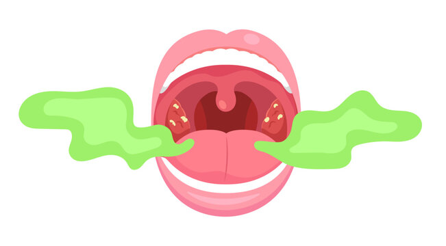 Bad breath mouth beacuse of tonsil stone. Flat vector of smelly mouth, oral health, hygiene.