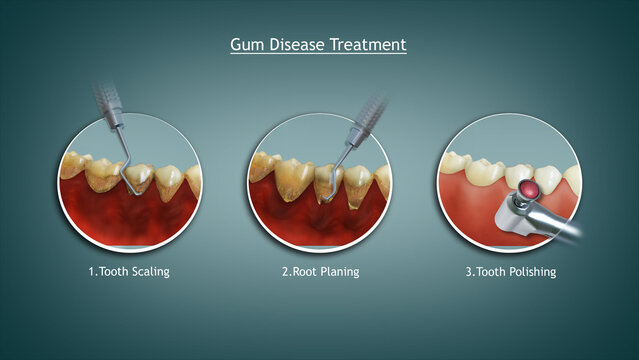 Gum disease treatment process.