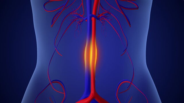 Swollen Aorta Vessel In Abdomen Medical Concept
