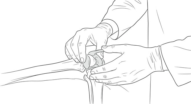 A detailed black and white line drawing captures a surgeon's gloved hands precisely adjusting an artificial knee joint component against a plain white background.