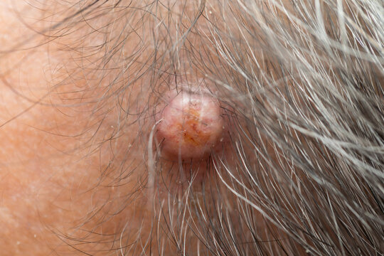 Close-up of scalp cyst (sebaceous cyst), small lump on human scalp caused by blocked oil glands, common skin condition, healthcare and dermatology concept