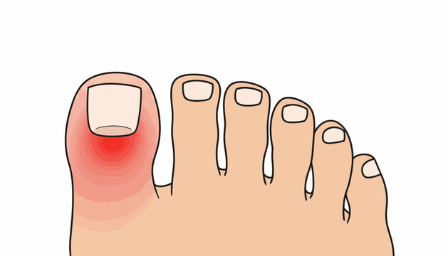 Ingrown toenail, toe pain, foot health, medical illustration, red inflamed toe
