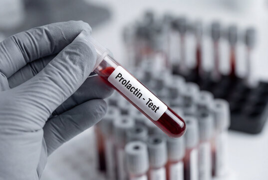 Hand in grey glove holding blood sample tube labeled prolactin test