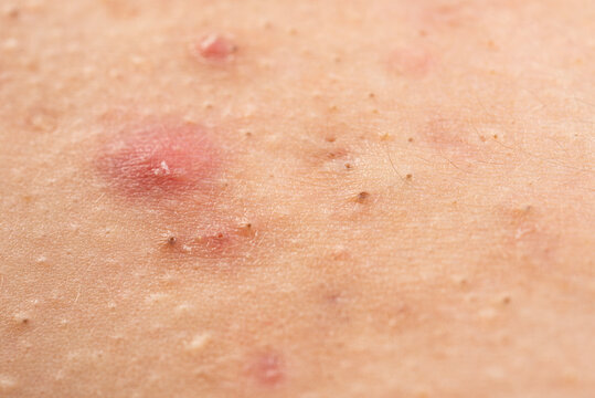 Macro shot of skin irritation with acne. Acne on skin closeup photo. Irritated skin with pimples acne texture. Detailed skin with acne.