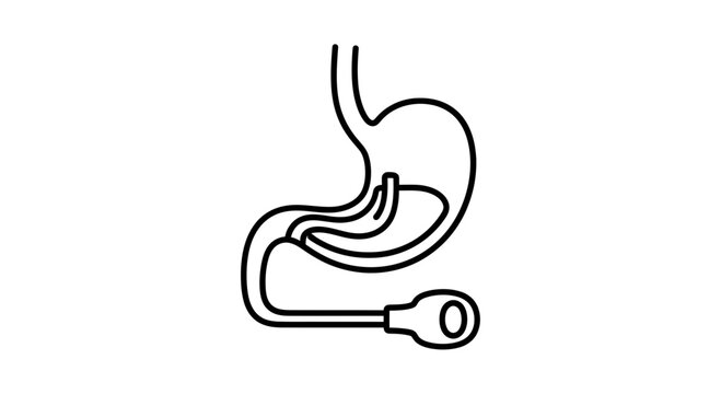 Gastric Bypass Surgery Diagram: Stomach, Intestine, and Band