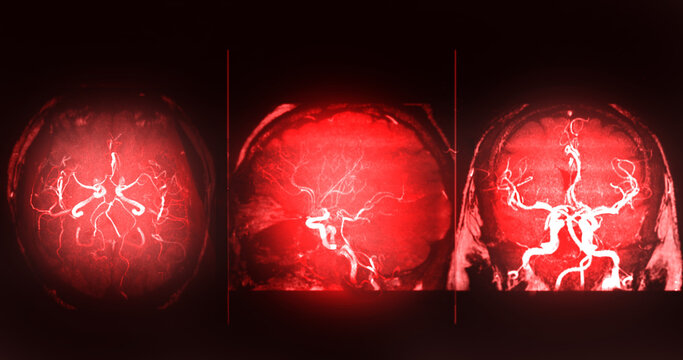 Collage of three glowing red MRI MRA brain scans showing axial, sagittal, and coronal views. Perfect for comprehensive neurology, brain tumor diagnosis, and medical presentations.