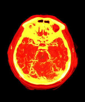 High-resolution CTA Brain and Carotid scan of a human brain in deep red and orange tones, detailing the cortical vascular structure. Excellent for neurological research and healthcare.