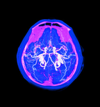 High-resolution Computed Tomography Angiography (CTA) scan showcasing the human brain and carotid arteries in the neck. Essential for diagnosing stroke, stenosis, and vascular health