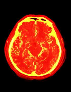High-resolution CTA Brain and Carotid scan of a human brain in deep red and orange tones, detailing the cortical vascular structure. Excellent for neurological research and healthcare.