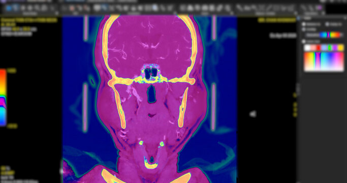 High-resolution Computed Tomography Angiography (CTA) scan showcasing the human brain and carotid arteries in the neck. Essential for diagnosing stroke, stenosis, and vascular health